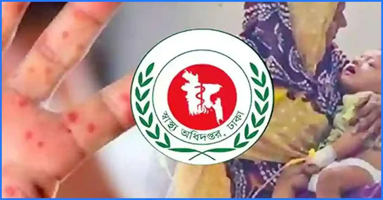 হাম ও এর উপসর্গে দেশে আরও ৯ শিশুর প্রাণহানি