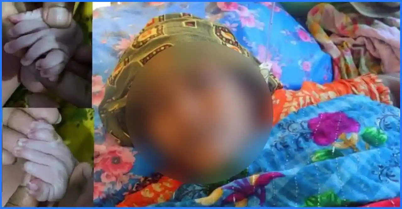 ৩০ আঙুল ও জিহ্বাবিহীন বিরল শিশুর জন্ম, এলাকায় চাঞ্চল্য