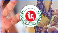 হাম ও এর উপসর্গে দেশে আরও ৯ শিশুর প্রাণহানি