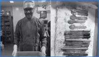 নারীর পেট থেকে ১৪টি কলম ও চামচসহ ২০টি বস্তু উদ্ধার